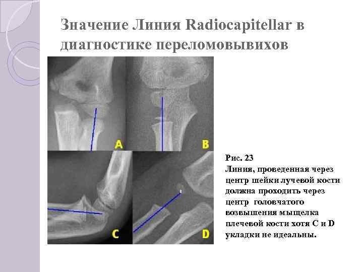 Значение Линия Radiocapitellar в диагностике переломовывихов Рис. 23 Линия, проведенная через центр шейки лучевой