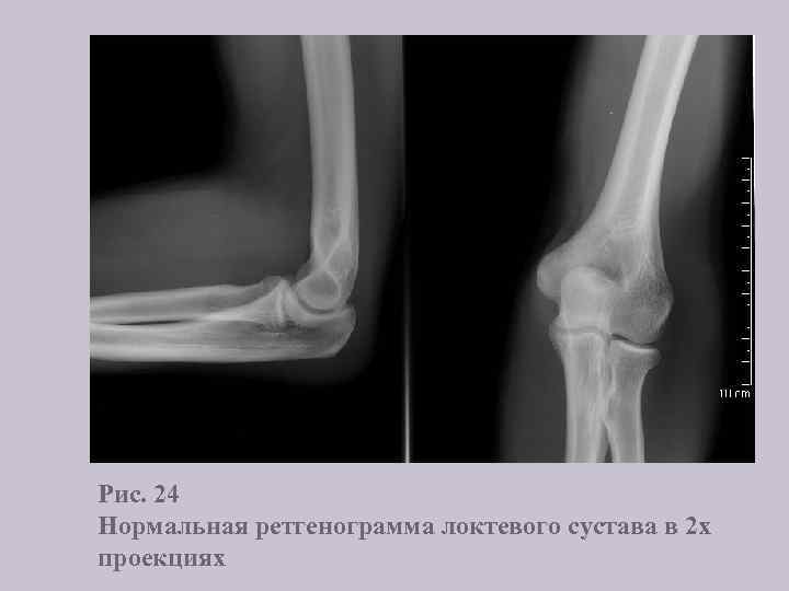 Рис. 24 Нормальная ретгенограмма локтевого сустава в 2 х проекциях 