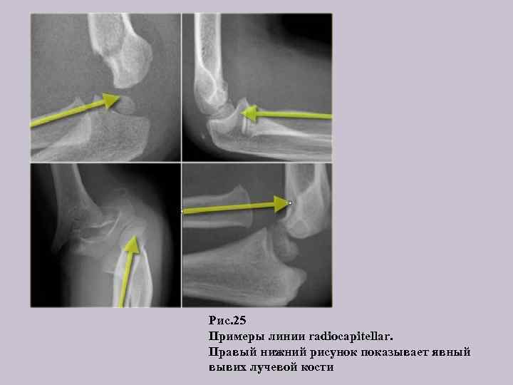 Рис. 25 Примеры линии radiocapitellar. Правый нижний рисунок показывает явный вывих лучевой кости 