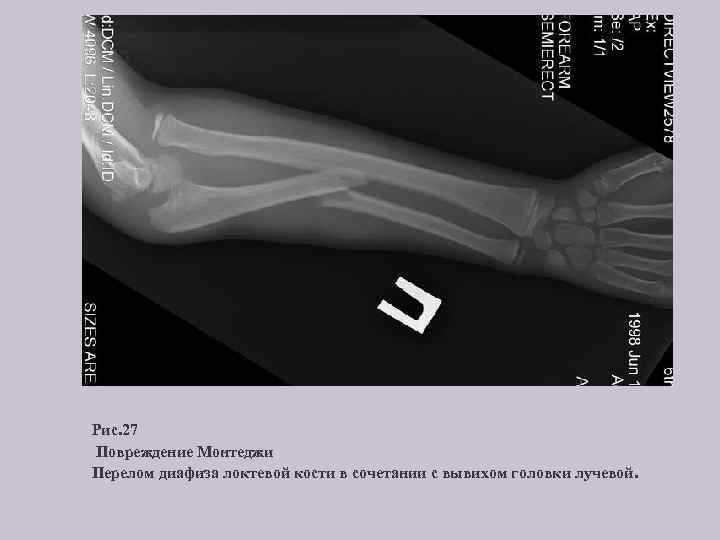 Рис. 27 Повреждение Монтеджи Перелом диафиза локтевой кости в сочетании с вывихом головки лучевой.