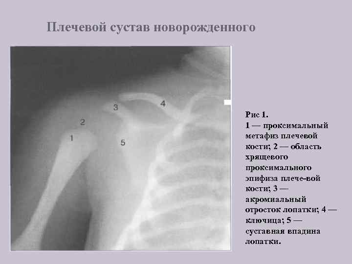 Плечевой сустав новорожденного Рис 1. 1 — проксимальный метафиз плечевой кости; 2 — область