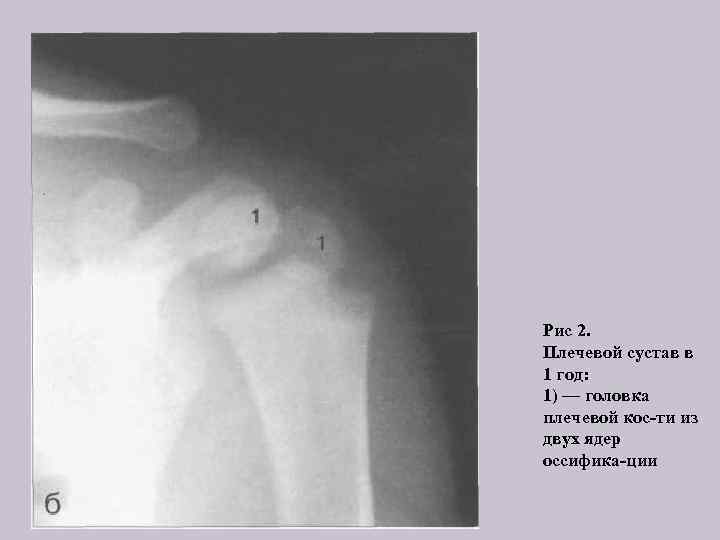 Рис 2. Плечевой сустав в 1 год: 1) — головка плечевой кос ти из