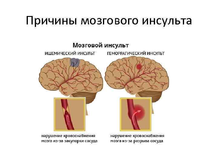 Причины мозгового инсульта 