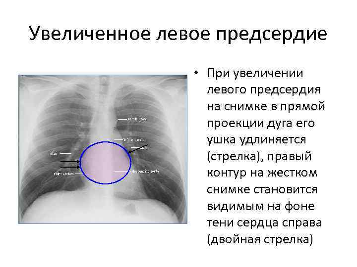 Увеличенное левое предсердие • При увеличении левого предсердия на снимке в прямой проекции дуга