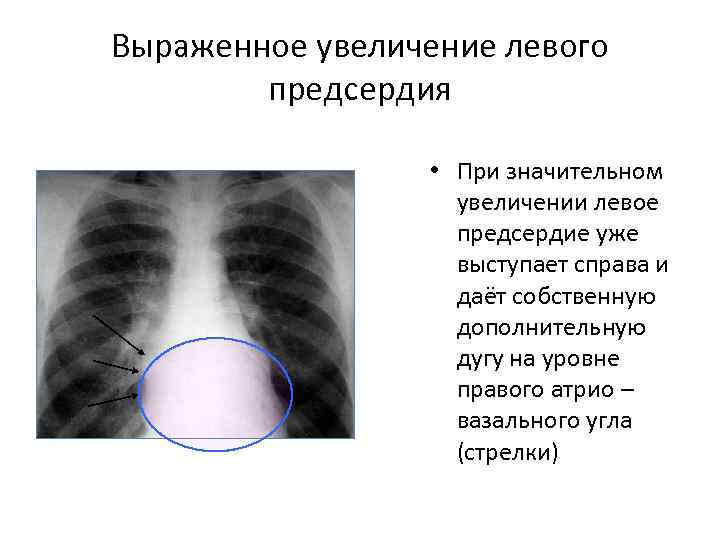 Выраженное увеличение левого предсердия • При значительном увеличении левое предсердие уже выступает справа и