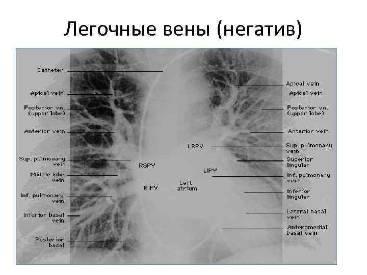 Легочной вене. Сегментарные ветви легочной артерии. Ветви легочной артерии на кт.