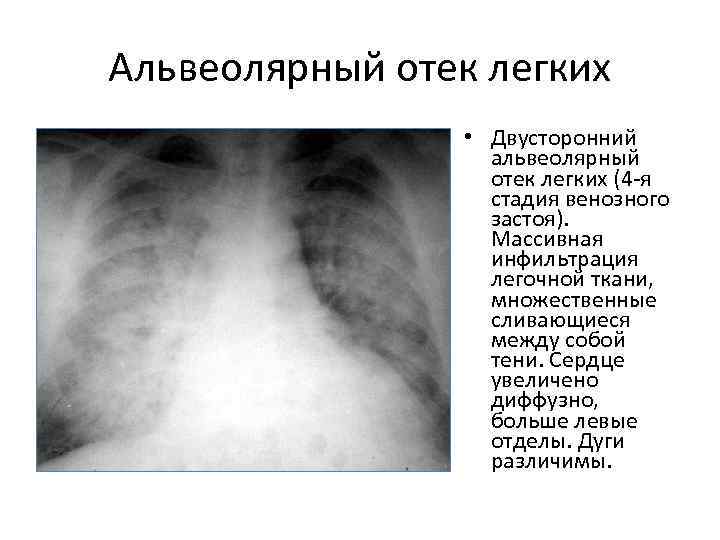 Альвеолярный отек легких • Двусторонний альвеолярный отек легких (4 -я стадия венозного застоя). Массивная