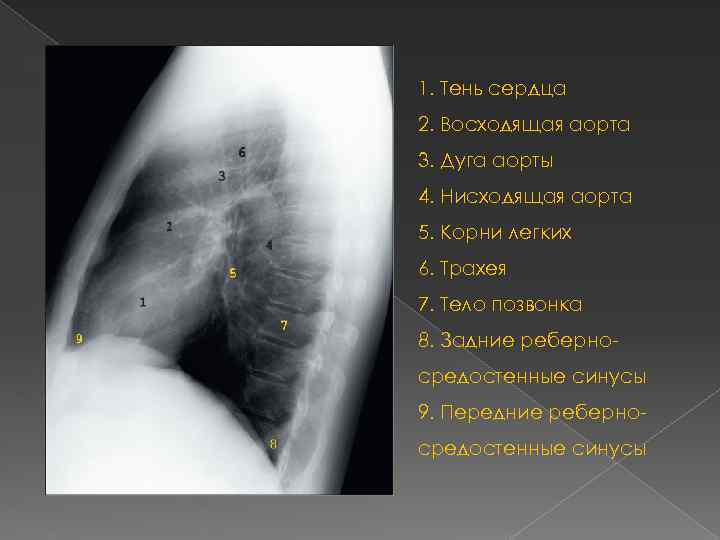 Тень сердца расширена