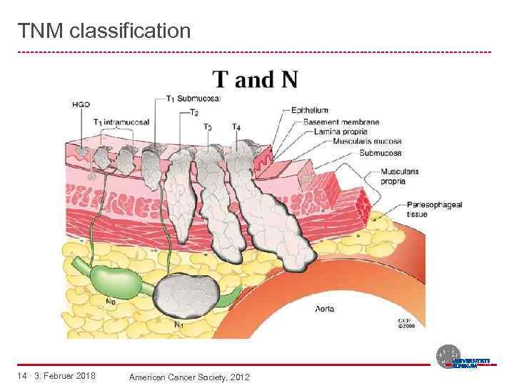 TNM classification -------------------------------------------------------- 14 · 3. Februar 2018 American Cancer Society, 2012 