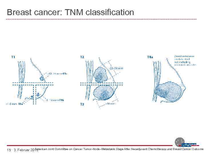 Breast cancer: TNM classification American Joint Committee on Cancer Tumor–Node–Metastasis Stage After Neoadjuvant Chemotherapy