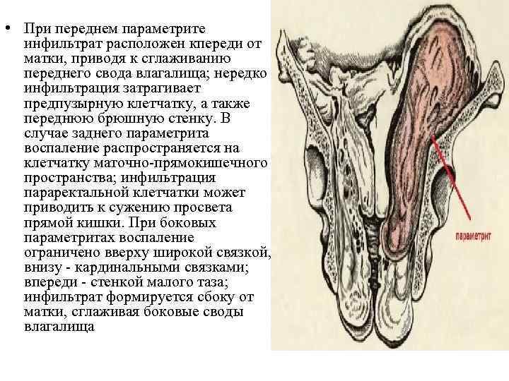  • При переднем параметрите инфильтрат расположен кпереди от матки, приводя к сглаживанию переднего