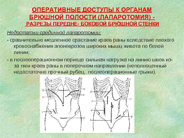 ОПЕРАТИВНЫЕ ДОСТУПЫ К ОРГАНАМ БРЮШНОЙ ПОЛОСТИ (ЛАПАРОТОМИЯ) РАЗРЕЗЫ ПЕРЕДНЕ- БОКОВОЙ БРЮШНОЙ СТЕНКИ Недостатки срединной