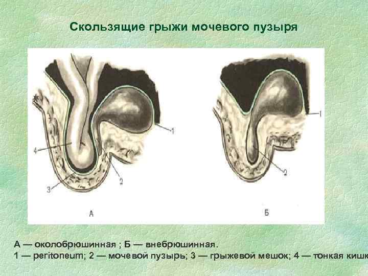 Скользящие грыжи мочевого пузыря А — околобрюшинная ; Б — внебрюшинная. 1 — peritoneum;