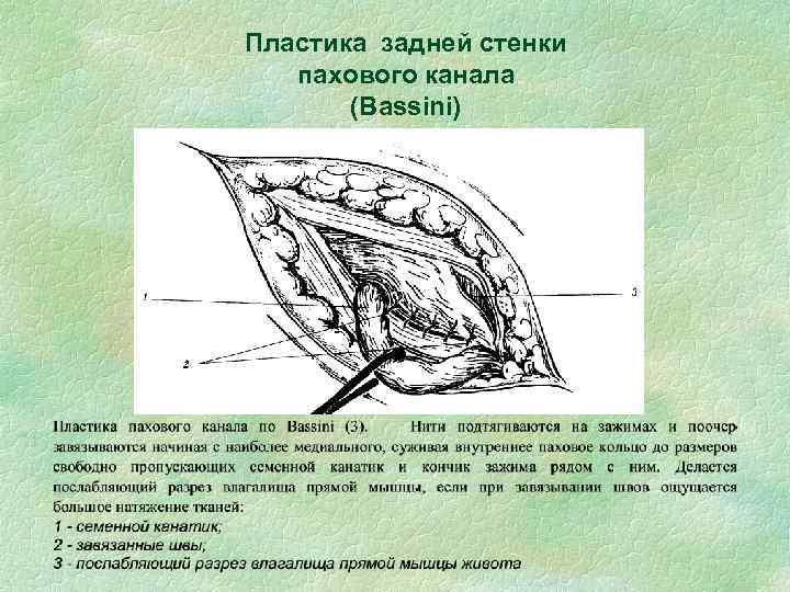 Схема топографии пахового канала