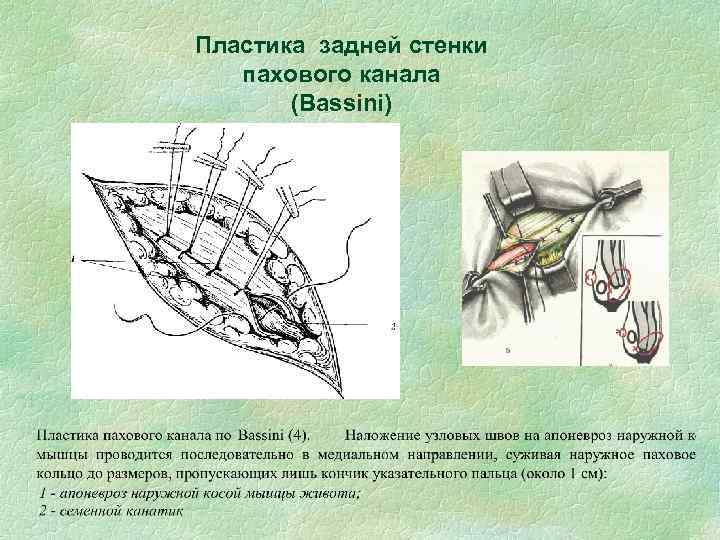 Схема топографии пахового канала