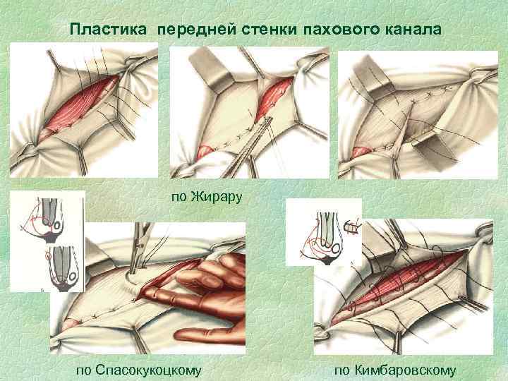 Пластика передней стенки пахового канала по Жирару по Спасокукоцкому по Кимбаровскому 