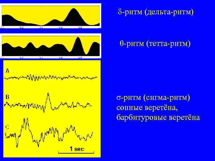 δ-ритм (дельта-ритм) θ-ритм (тетта-ритм) σ-ритм (сигма-ритм) сонные веретёна, барбитуровые веретёна 