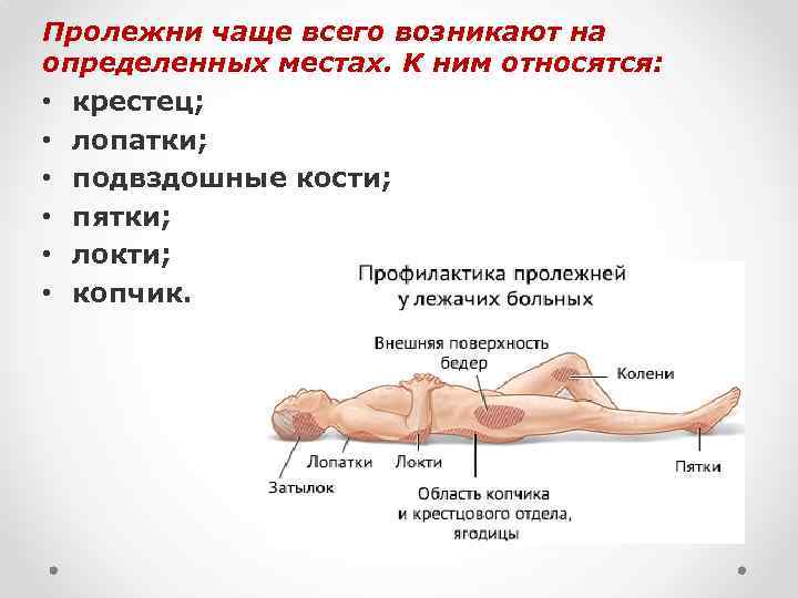 Пролежни чаще всего возникают на определенных местах. К ним относятся: • крестец; • лопатки;