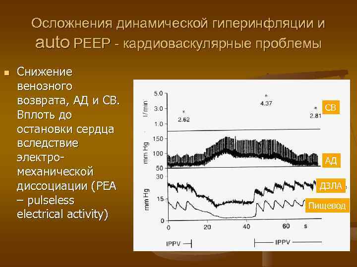 Осложнения динамической гиперинфляции и auto РЕЕР - кардиоваскулярные проблемы n Снижение венозного возврата, АД