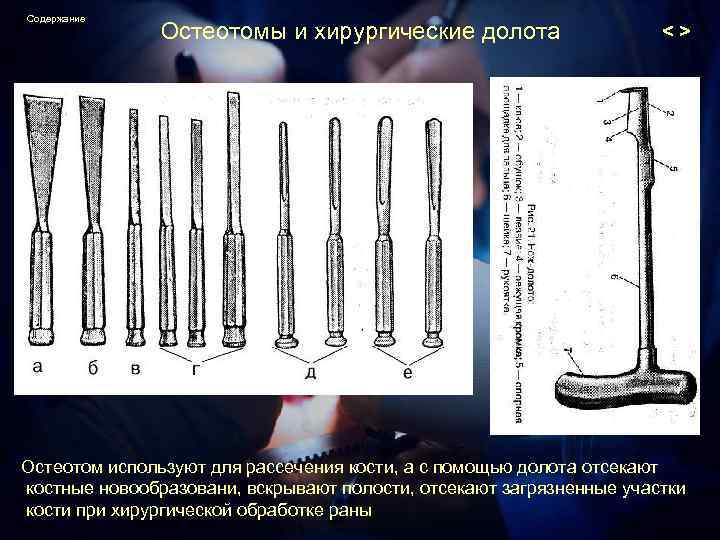 Содержание Остеотомы и хирургические долота <> Остеотом используют для рассечения кости, а с помощью