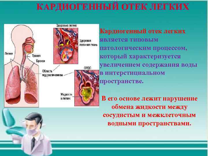 КАРДИОГЕННЫЙ ОТЕК ЛЕГКИХ Кардиогенный отек легких является типовым патологическим процессом, который характеризуется увеличением содержания