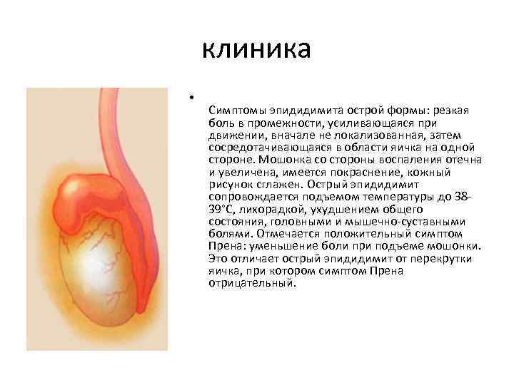 клиника • Симптомы эпидидимита острой формы: резкая боль в промежности, усиливающаяся при движении, вначале