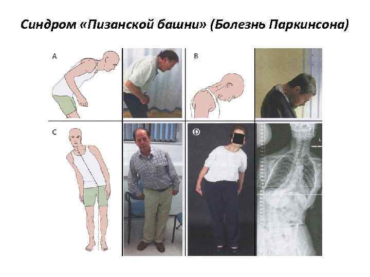 Синдром «Пизанской башни» (Болезнь Паркинсона) 