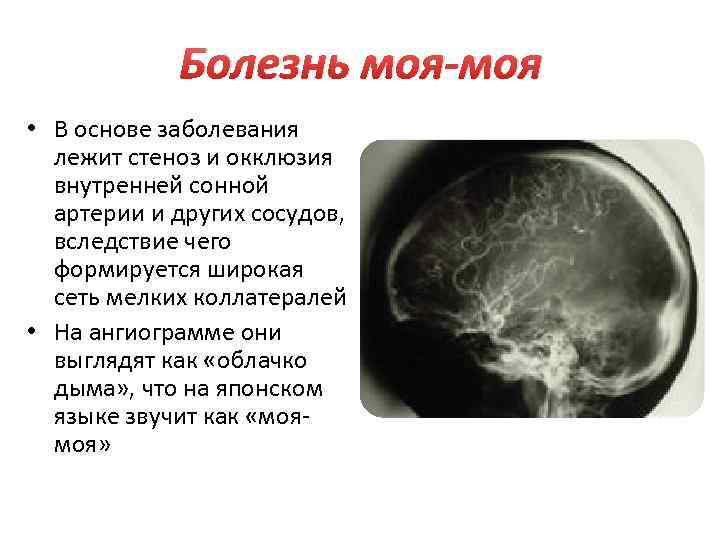 Болезнь моя-моя • В основе заболевания лежит стеноз и окклюзия внутренней сонной артерии и