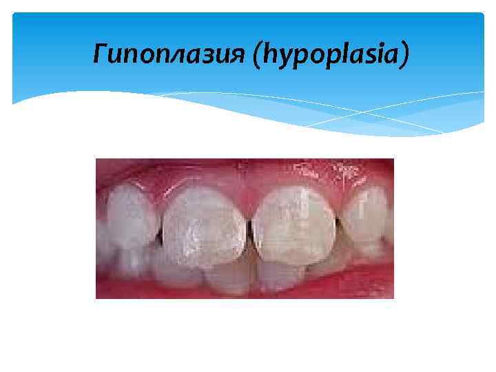 Гипоплазия (hypoplasia) 