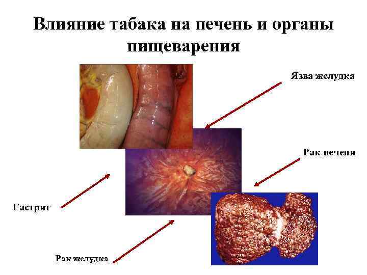 Влияние табака на печень и органы пищеварения Язва желудка Рак печени Гастрит Рак желудка