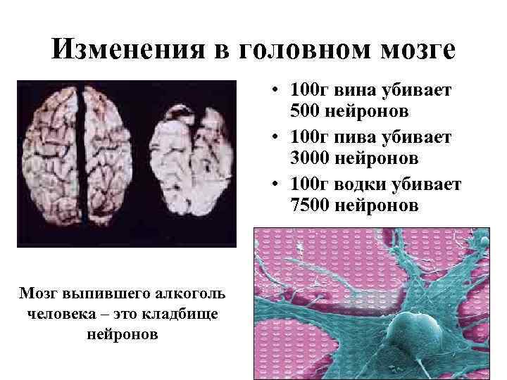 Изменения в головном мозге • 100 г вина убивает 500 нейронов • 100 г