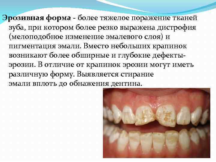 Эрозивная форма - более тяжелое поражение тканей зуба, при котором более резко выражена дистрофия