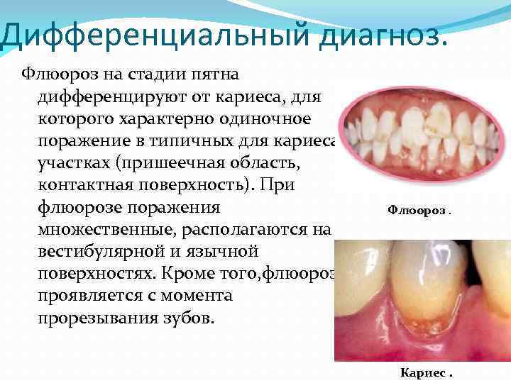 Флюороз и гипоплазия фото