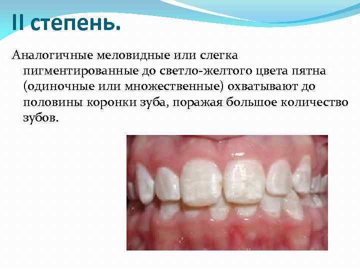 II степень. Аналогичные меловидные или слегка пигментированные до светло-желтого цвета пятна (одиночные или множественные)