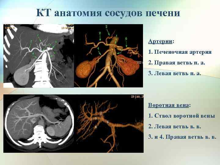 КТ анатомия сосудов печени Артерии: 1. Печеночная артерия 2. Правая ветвь п. а. 3.