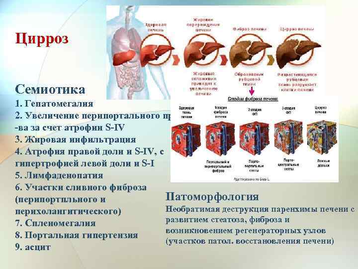 Цирроз Семиотика 1. Гепатомегалия 2. Увеличение перипортального пр -ва за счет атрофии S-IV 3.