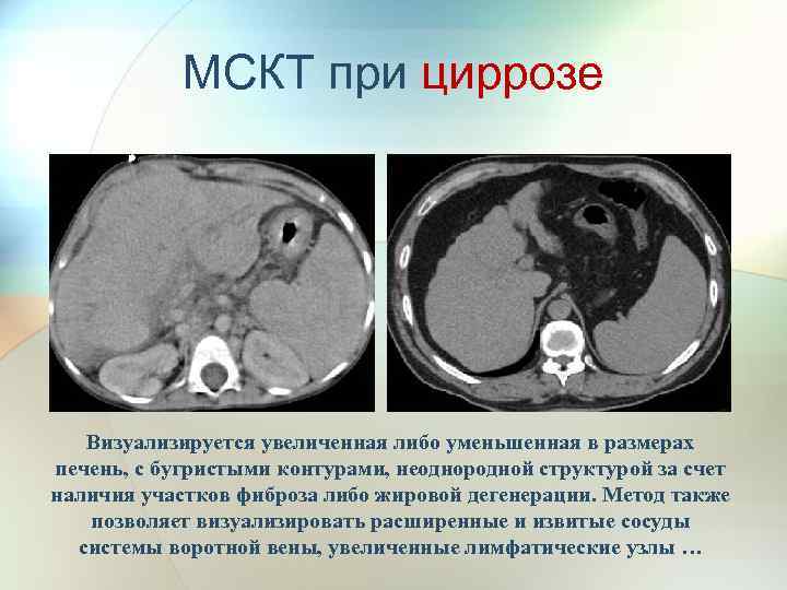 МСКТ при циррозе Визуализируется увеличенная либо уменьшенная в размерах печень, с бугристыми контурами, неоднородной