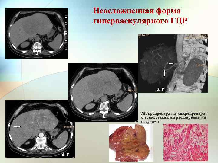 Неосложненная форма гиперваскулярного ГЦР A-F P-F A-F Макропрепарат и микропрепарат с тонкостенными расширенными сосудами