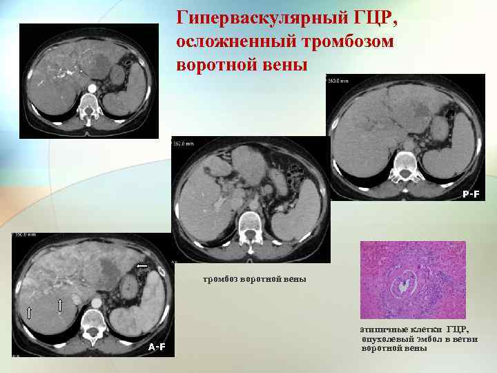 Гиперваскулярный ГЦР, осложненный тромбозом воротной вены P-F Р-F тромбоз воротной вены атипичные клетки ГЦР,