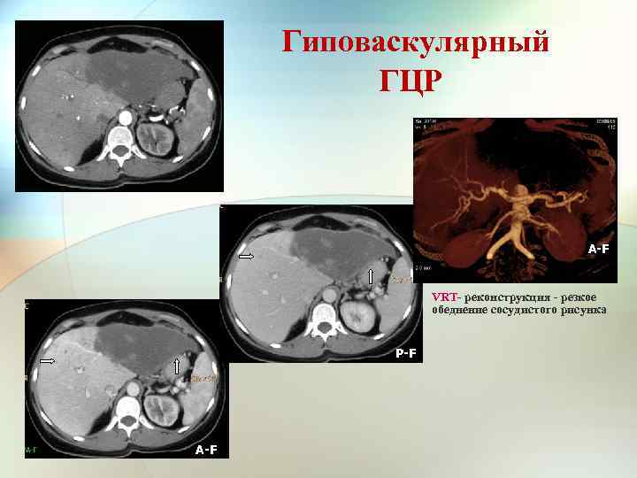  Гиповаскулярный ГЦР A-F VRT- реконструкция - резкое обеднение сосудистого рисунка P-F A-F 