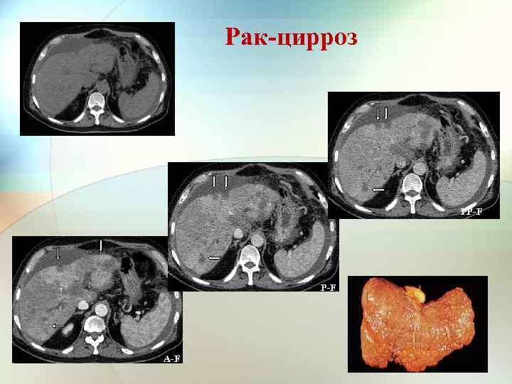 Рак-цирроз PP-F A-F 