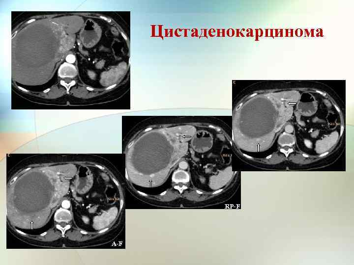 Цистаденокарцинома PP-F RP-F A-F 