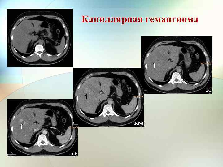 Капиллярная гемангиома I-F RP-F A-F 