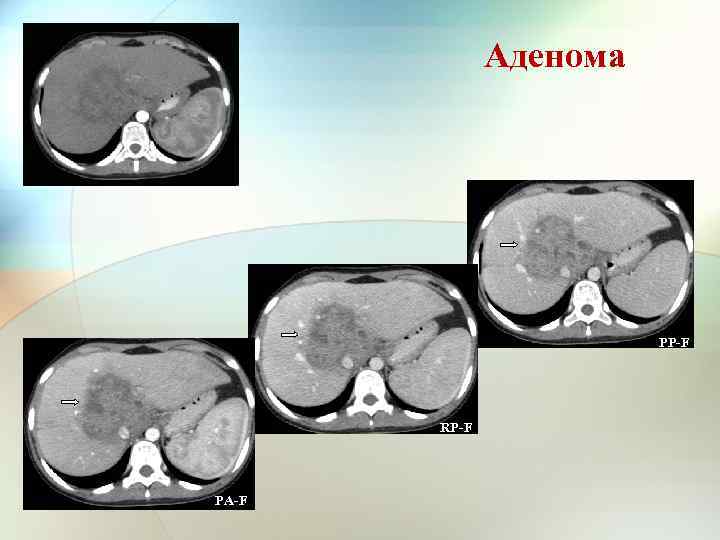 Аденома PP-F RP-F PA-F 