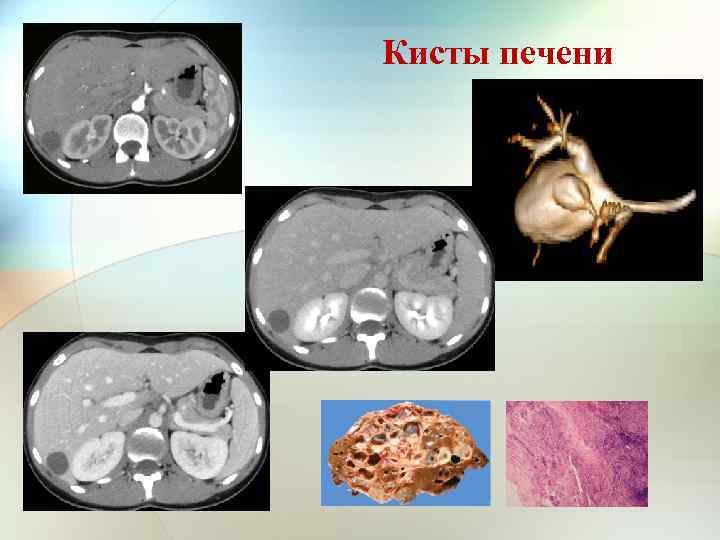 Кисты печени 