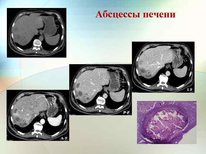 Абсцесс печени. Амебный абсцесс печени кт. Холангиогенные абсцессы кт. Холангиогенный абсцесс кт. Холангиогенный абсцесс печени кт.