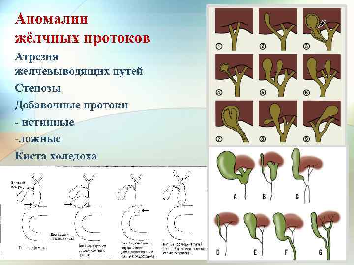 Аномалии жёлчных протоков Атрезия желчевыводящих путей Стенозы Добавочные протоки - истинные -ложные Киста холедоха