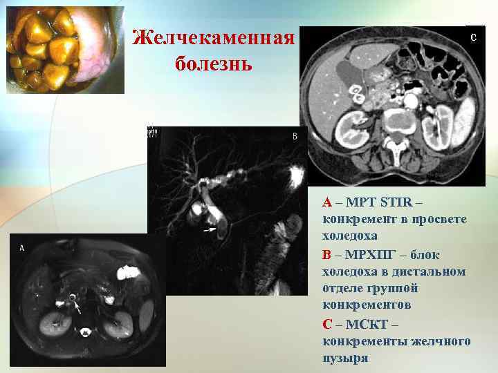 Желчекаменная болезнь с А – МРТ STIR – конкремент в просвете холедоха В –