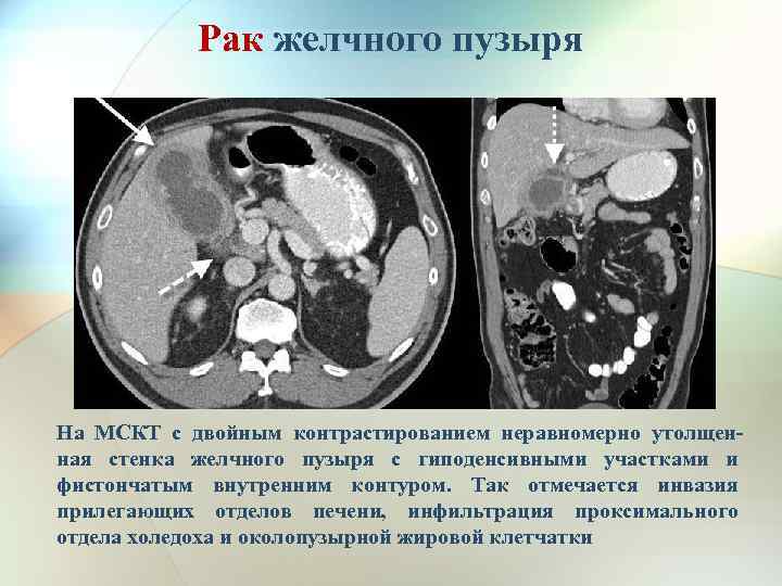 Рак желчного пузыря На МСКТ с двойным контрастированием неравномерно утолщенная стенка желчного пузыря с