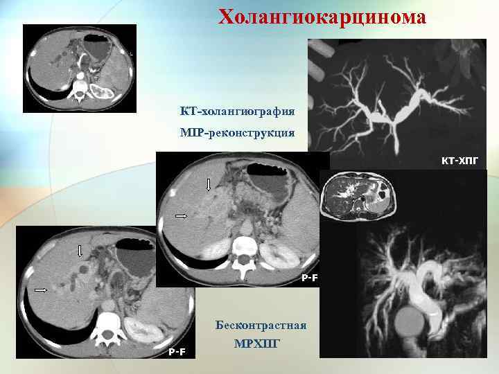 Холангиокарцинома КТ-холангиография MIP-реконструкция КТ-ХПГ P-F Бесконтрастная МРХПГ 